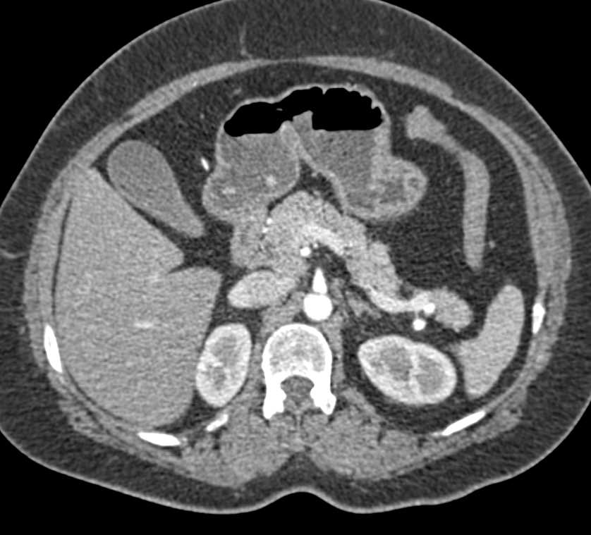 Carcinoid Tumor with Desmoplastic Reaction - CTisus CT Scan