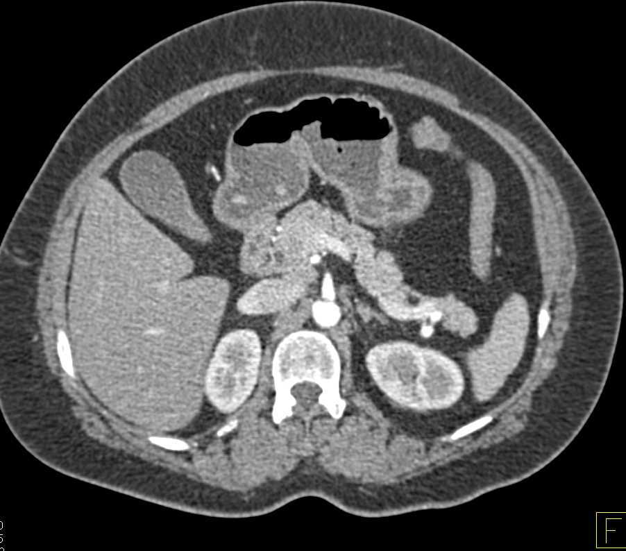 Carcinoid Tumor with Desmoplastic Reaction and Enhancing Small Bowel Tumors - CTisus CT Scan