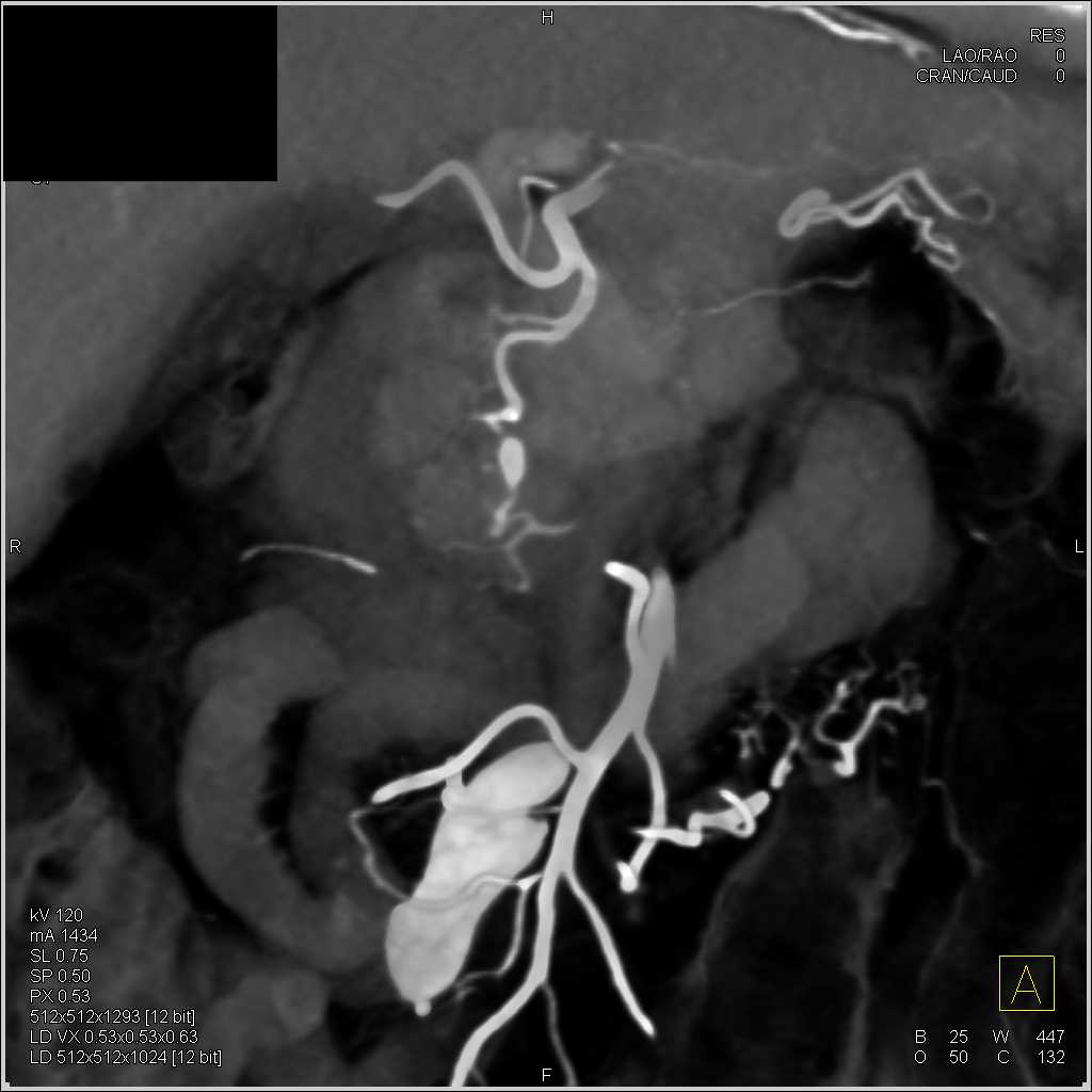 Active Bleed in the Mesentery - CTisus CT Scan