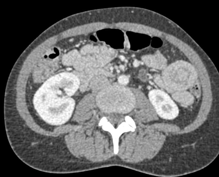 Intermittent Intussuception in the Left Lower Quadrant - CTisus CT Scan