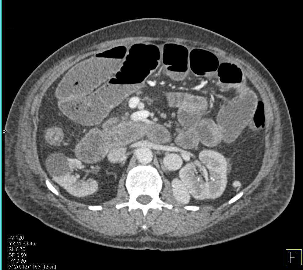 Small Bowel Obstruction due to Colon Cancer - CTisus CT Scan