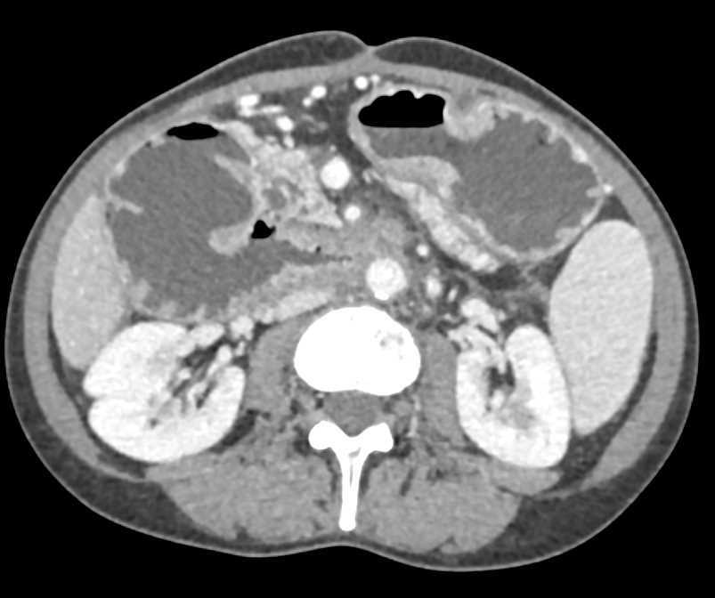 Duodenal Adenocarcinoma - CTisus CT Scan