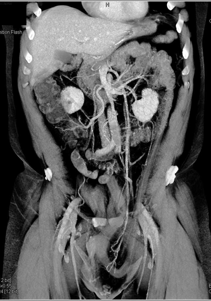 Small Bowel Herniates into the Scrotum - CTisus CT Scan