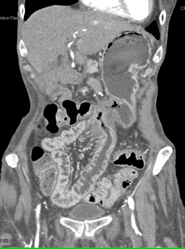 Small Bowel Enteritis with Gastro-Jejunal Anastomosis - CTisus CT Scan