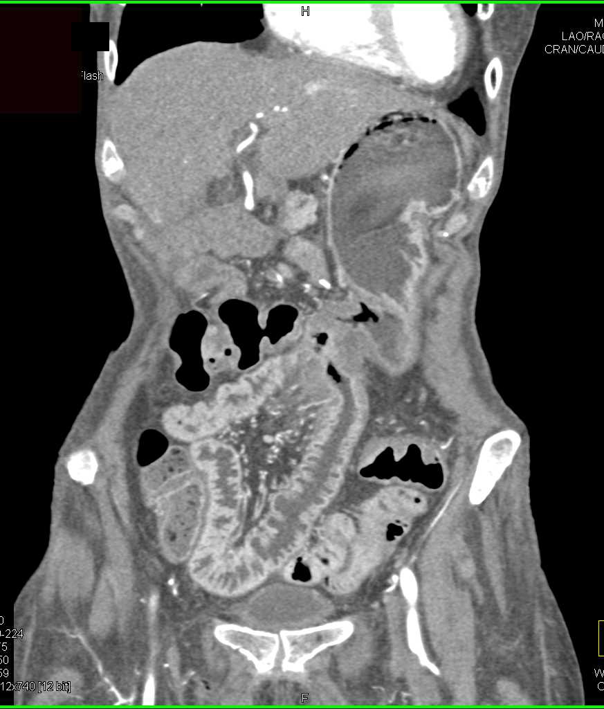 Small Bowel Enteritis with Gastro-Jejunal Anastomosis - CTisus CT Scan