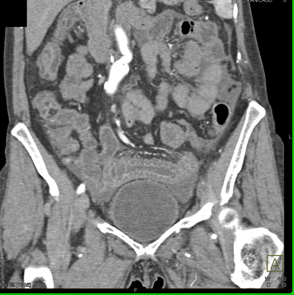 Angioedema Small Bowel due to ACE Inhibitors - CTisus CT Scan