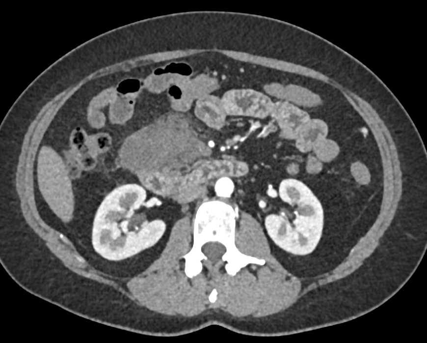 Perforated Duodenum and Abscess - CTisus CT Scan