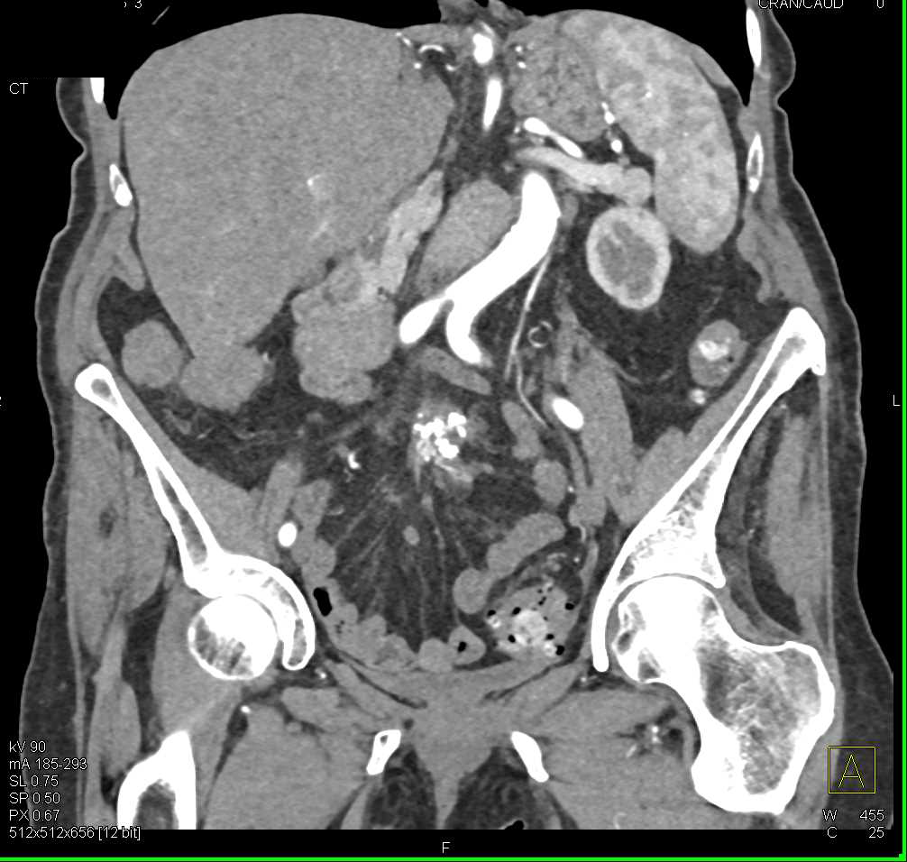 Sclerosing Mesenteritis - CTisus CT Scan