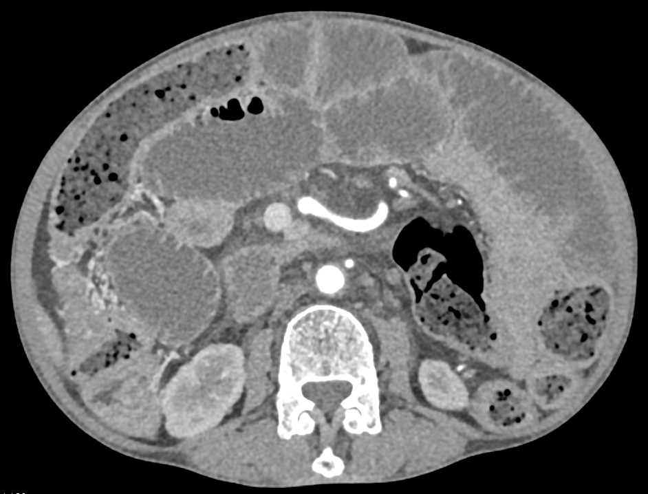 Small Bowel Obstruction (SBO) and Pelvic Varices - CTisus CT Scan