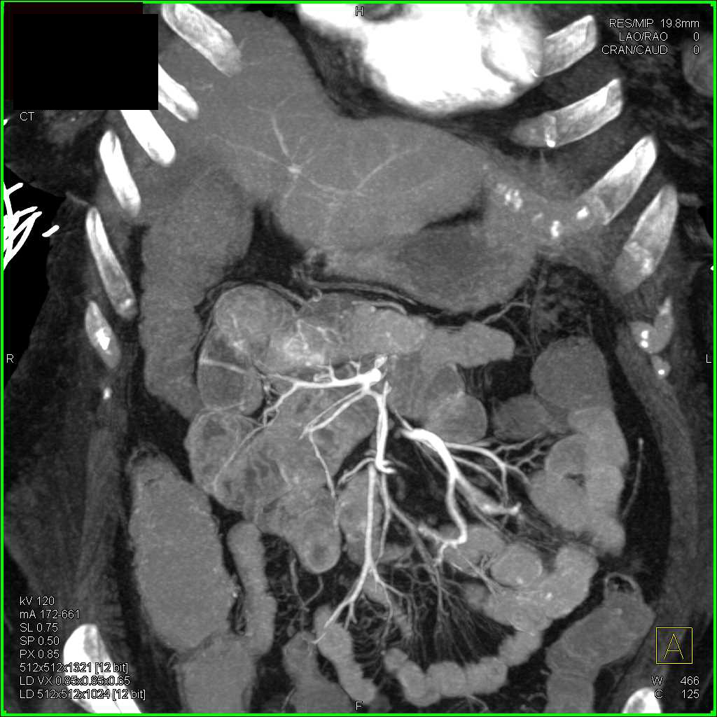 Angiodysplasia Proximal Small Bowel - CTisus CT Scan