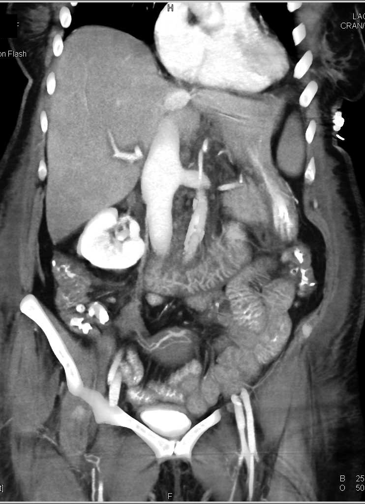 Early Shock Bowel with Clot in Celiac Artery - CTisus CT Scan