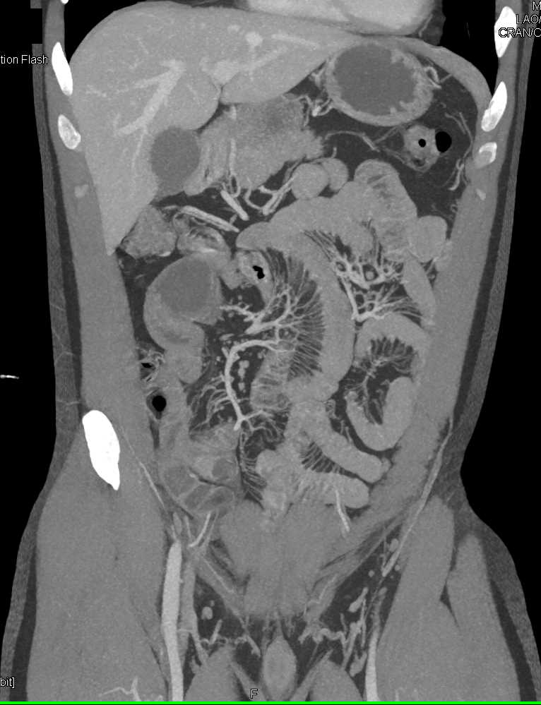 Crohn's Disease - CTisus CT Scan