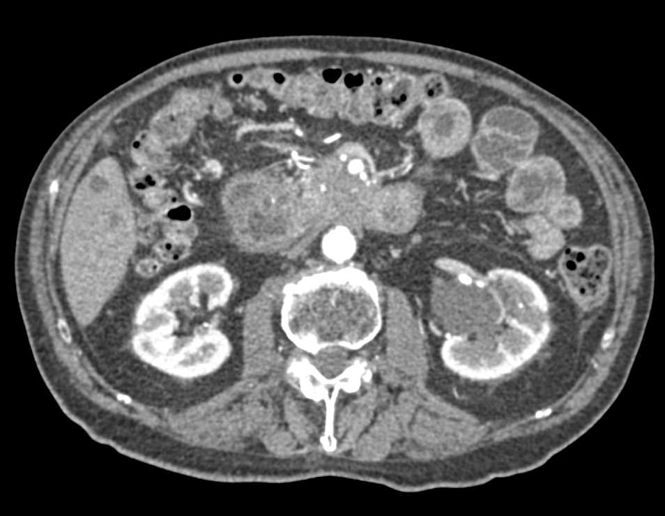 Duodenal Cancer Simulates a Pancreatic Mass - CTisus CT Scan