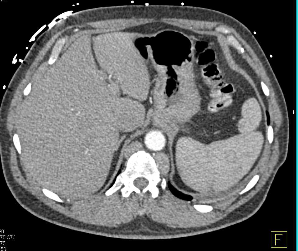 Carcinoid Tumor in the Root of the Mesentery - CTisus CT Scan