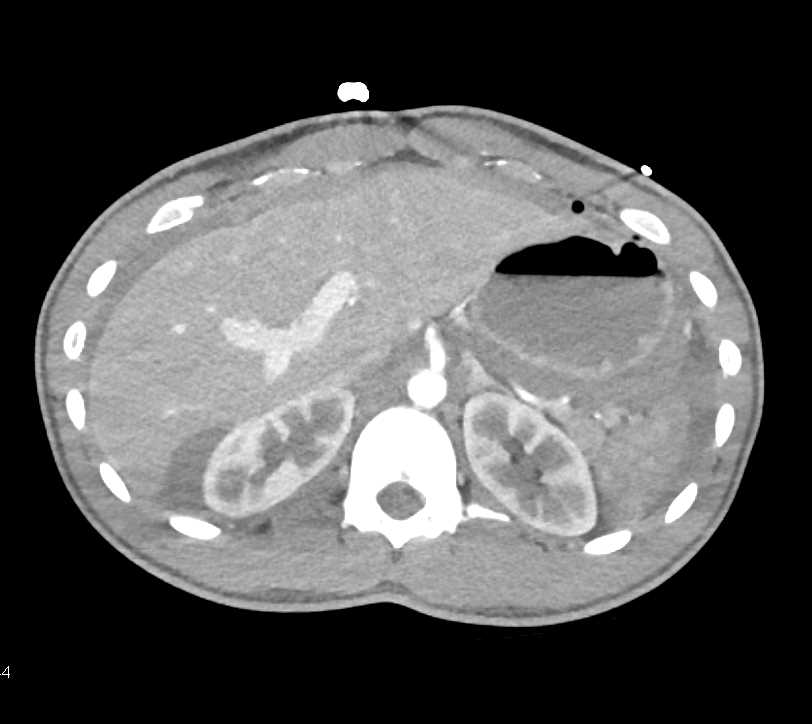 Gastrointestinal (GI) Bleed and Hemoperitoneum - CTisus CT Scan