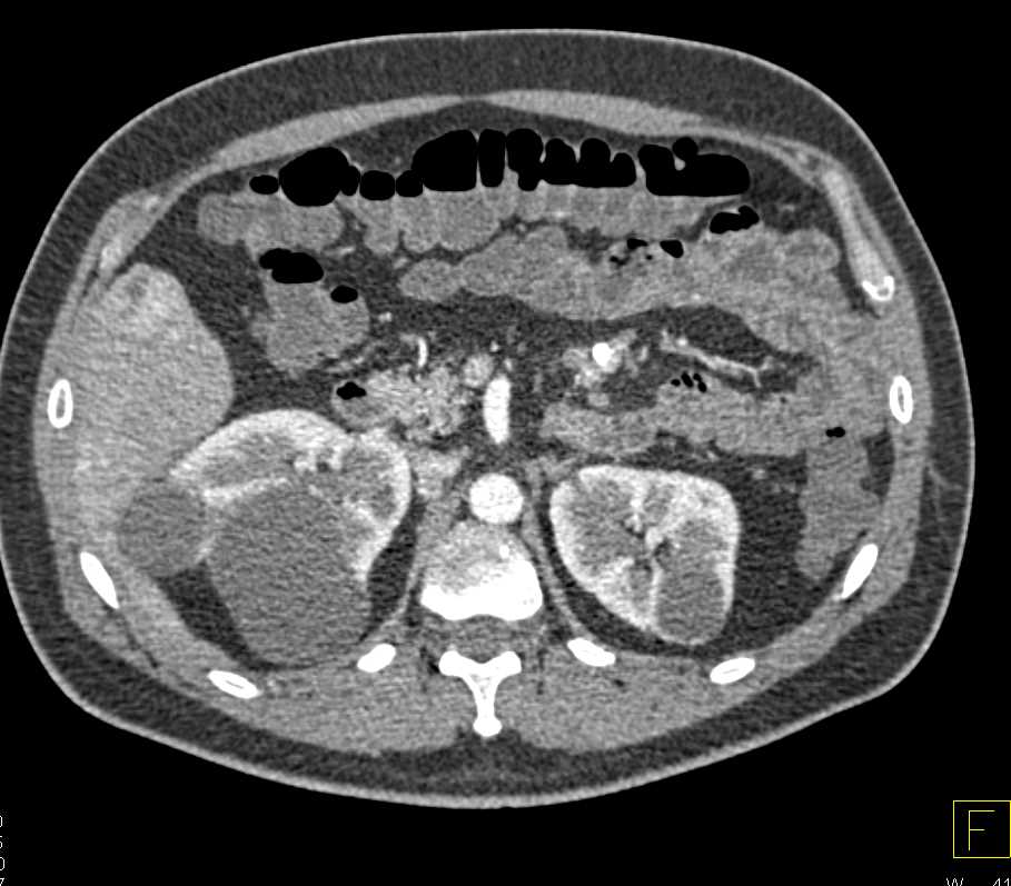 Jejunal Carcinoid Tumor with Liver Metastases - CTisus CT Scan