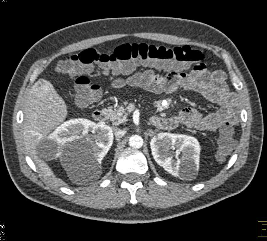 Jejunal Carcinoid Tumor with Liver Metastases - CTisus CT Scan