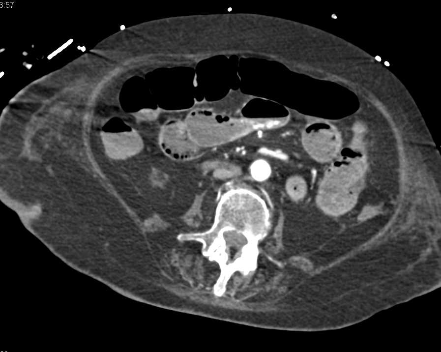 Active Gastrointestinal (GI) Bleed in the Small Bowel - CTisus CT Scan