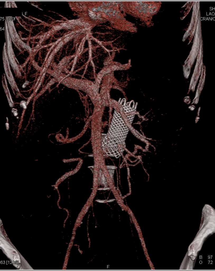 Stent in the Small Bowel - CTisus CT Scan