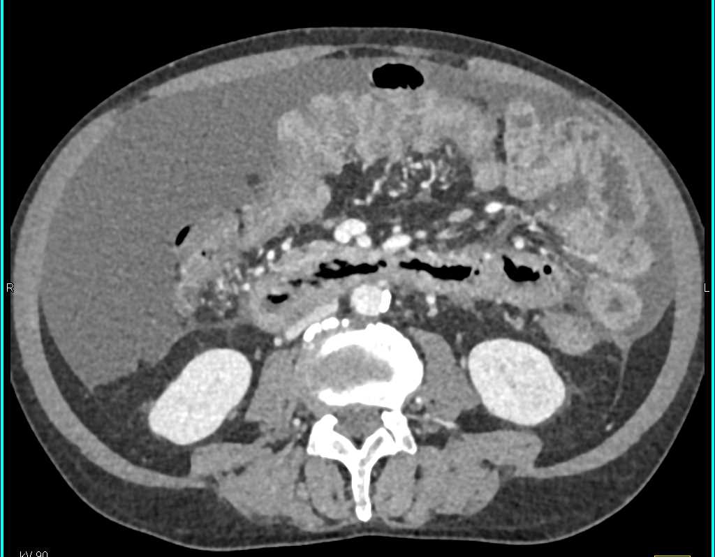 Duodenal Adenocarcinoma with Ascites - CTisus CT Scan