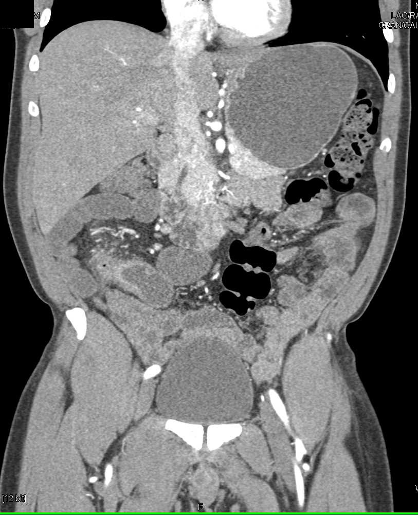 Crohn's Disease Involves the Terminal Ileum - CTisus CT Scan