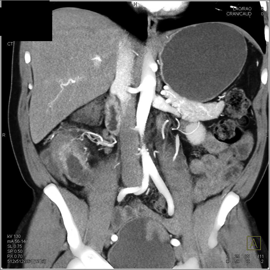 Crohn's Disease Involves the Terminal Ileum - CTisus CT Scan