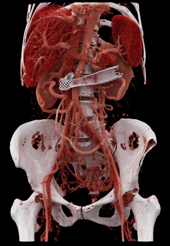 Stent in Duodenum due to Tumor Encasement with Cinematic Rendering - CTisus CT Scan