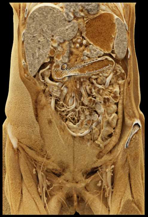 Stent in Duodenum due to Tumor Encasement with Cinematic Rendering - CTisus CT Scan