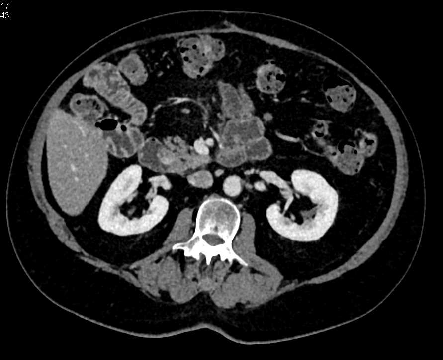 1cm Carcinoid Tumor Duodenum - CTisus CT Scan