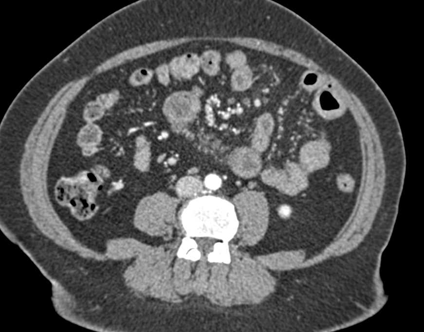 Duodenal Carcinoid Infiltrates  the 4th Portion Duodenum - CTisus CT Scan