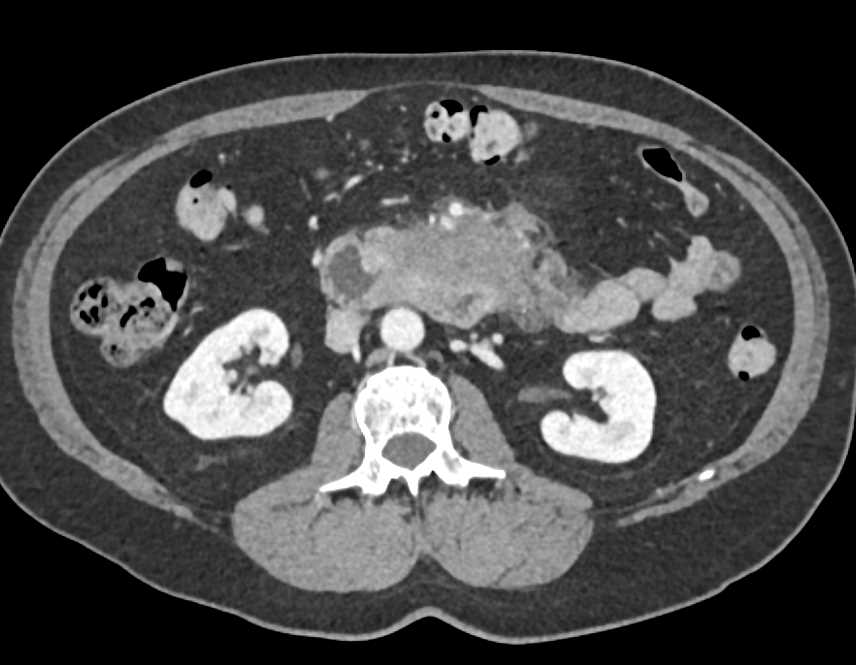 Duodenal Adenocarcinoma with Spread Into the Mesentery - CTisus CT Scan