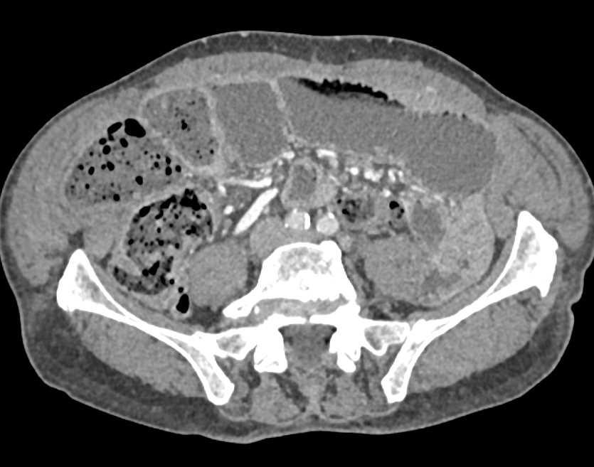 Thickened Small Bowel due to Enteritis - CTisus CT Scan