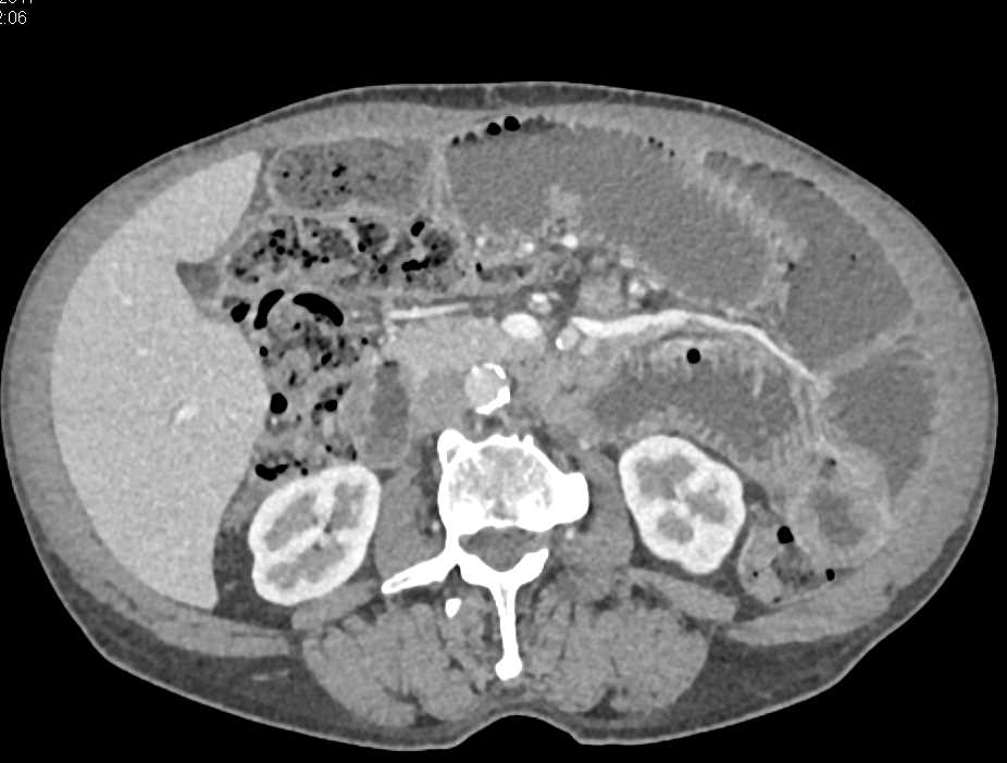 Dilated Small Bowel with Feces Sign - CTisus CT Scan