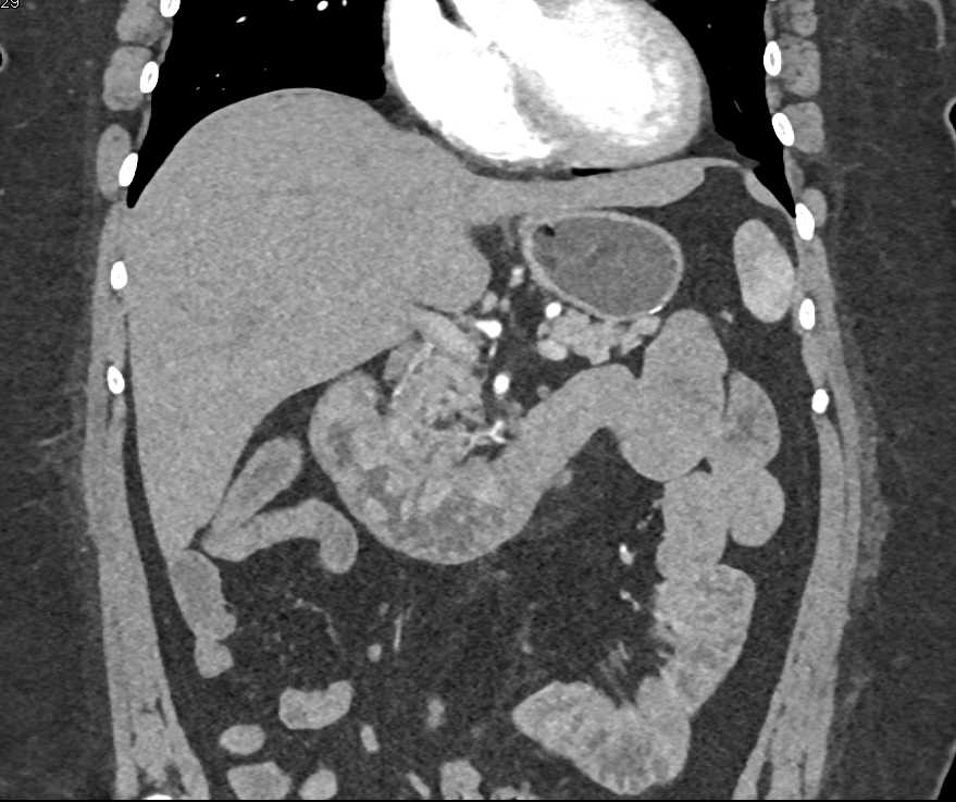 Duodenal Adenocarcinoma - CTisus CT Scan