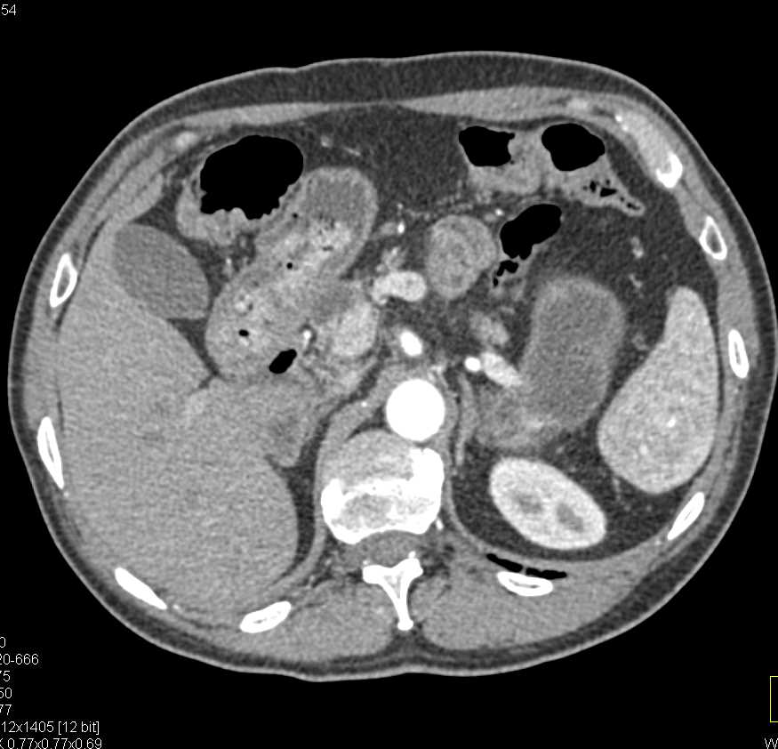 Duodenal Diverticulum Simulates a Mass - CTisus CT Scan