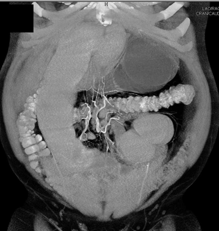 Small Bowel Obstruction (SBO) due to Adhesions - CTisus CT Scan