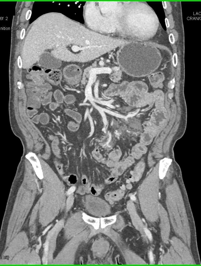 Mycobacterium avium/intracellulare (MAI) Mesenteric Nodes - CTisus CT Scan