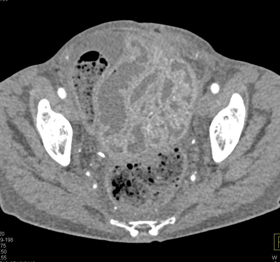 Small Bowel Enteritis - CTisus CT Scan