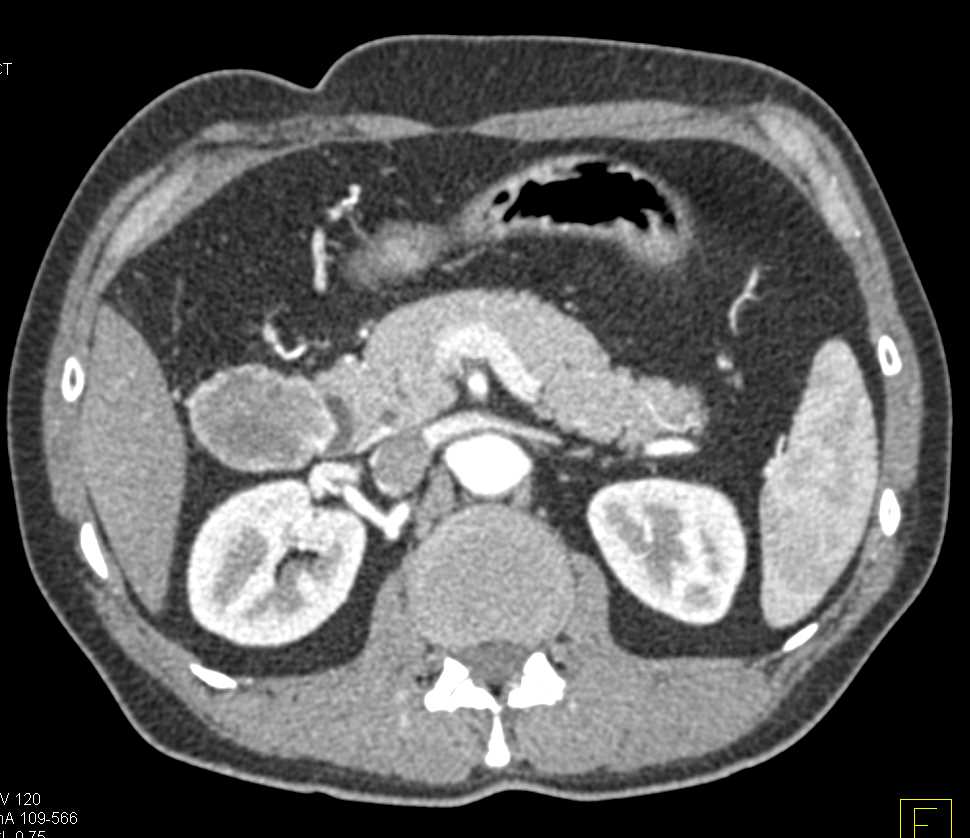 GIST Tumor Duodenum - CTisus CT Scan