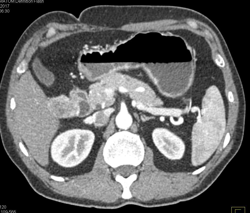 GIST Duodenum - CTisus CT Scan