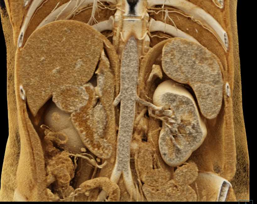 GIST Duodenum with Cinematic Rendering - CTisus CT Scan