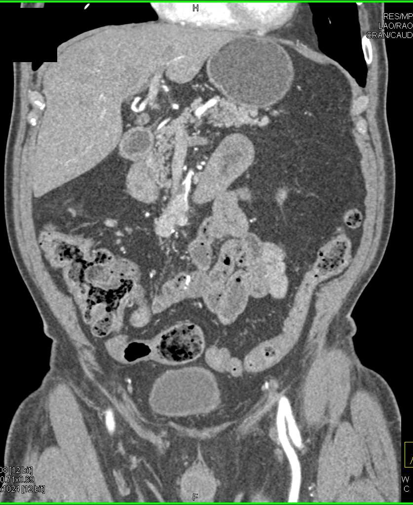 Carcinoid Tumor with Multiple Implants - CTisus CT Scan