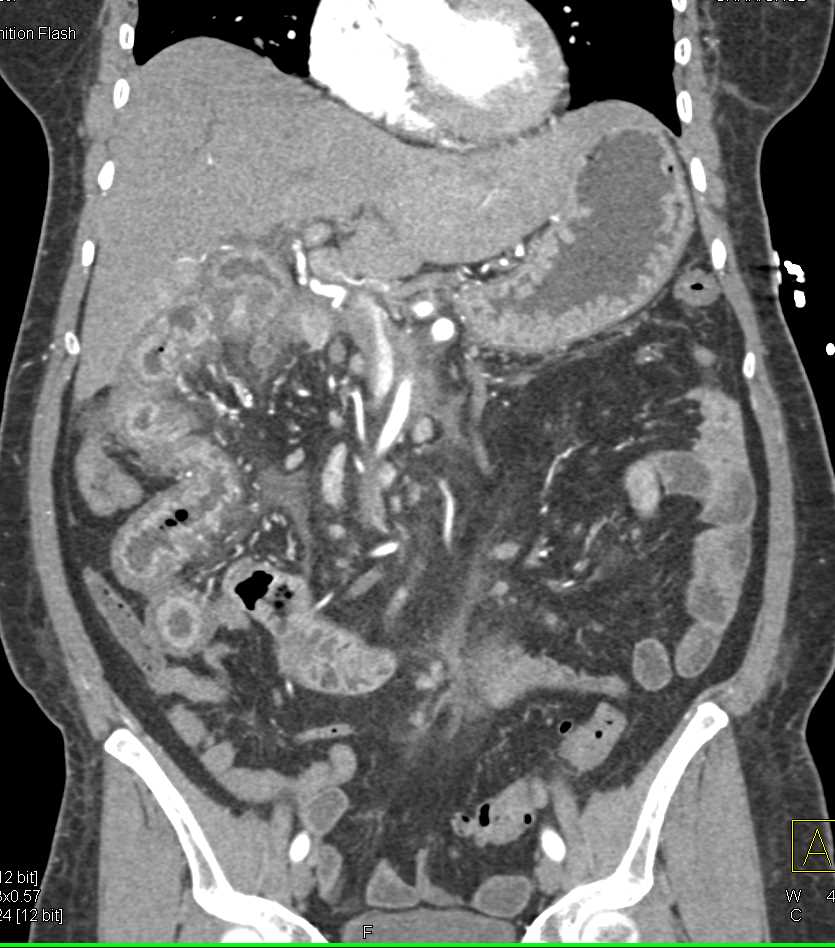 Chemotherapy Induced Enteritis - CTisus CT Scan