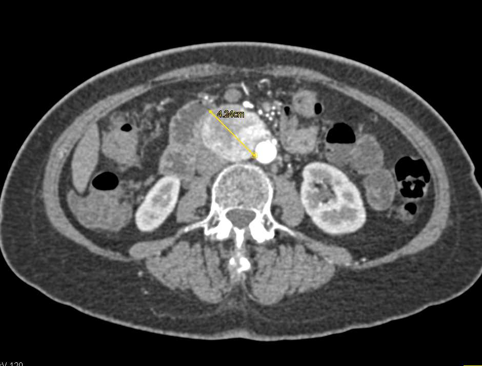 Carcinoid Tumor in the Root of the Mesentery - CTisus CT Scan