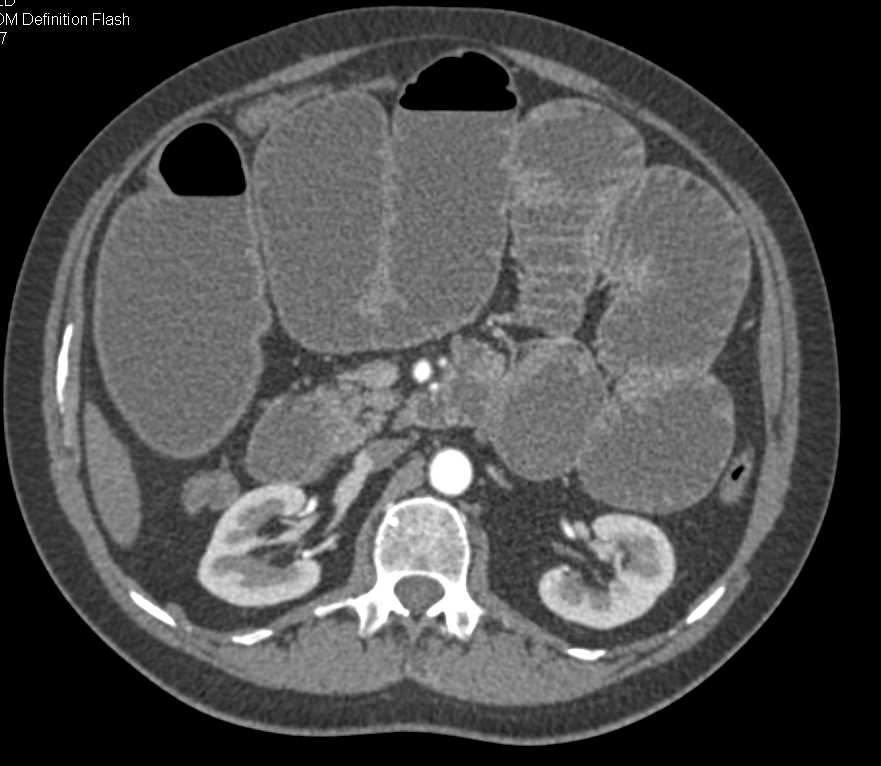 Small Bowel Obstruction with Thickened Ileum due to Crohn's Disease - CTisus CT Scan
