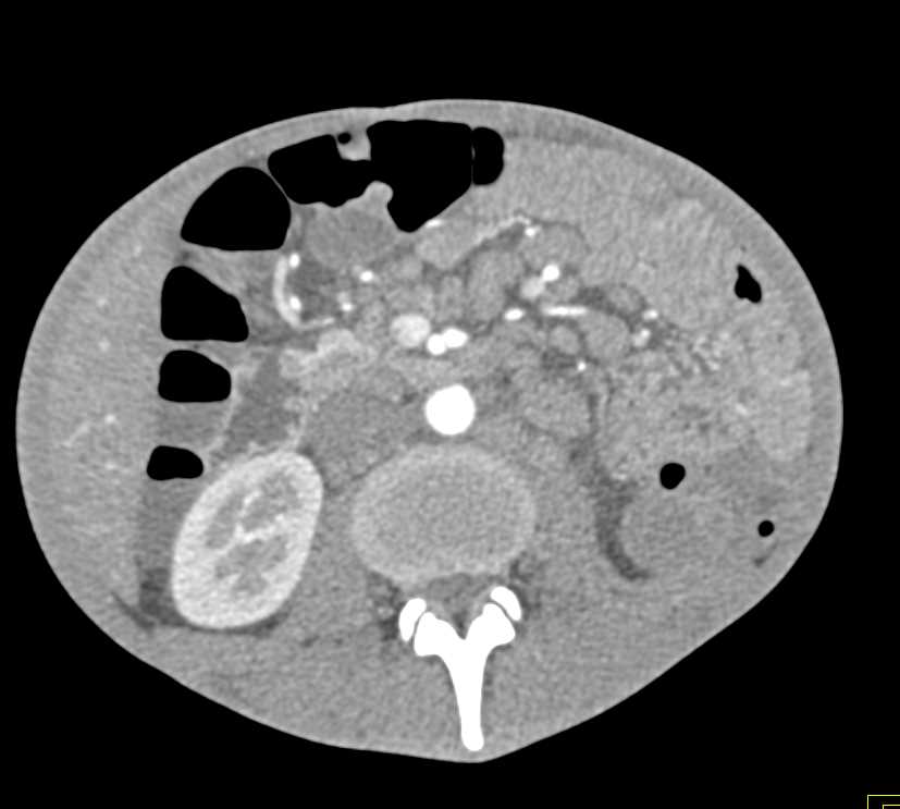 Mycobacterium avium/intracellulare (MAI) with Mesenteric Lymphadenopathy - CTisus CT Scan