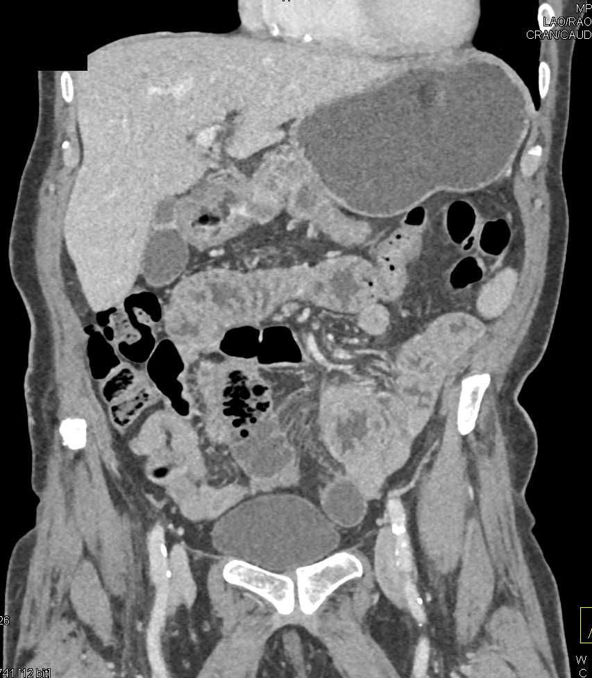 Small Bowel Lipoma - CTisus CT Scan