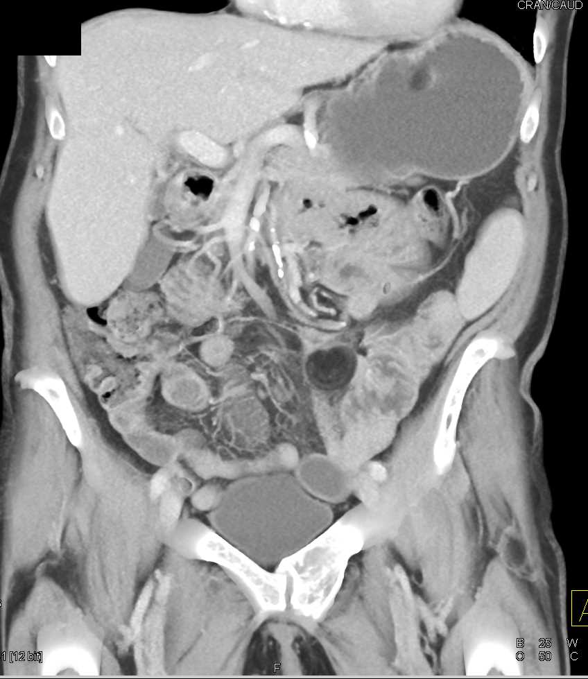 Small Bowel Lipoma - CTisus CT Scan