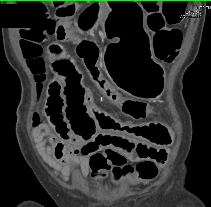 Inflammed Small Bowel - CTisus CT Scan