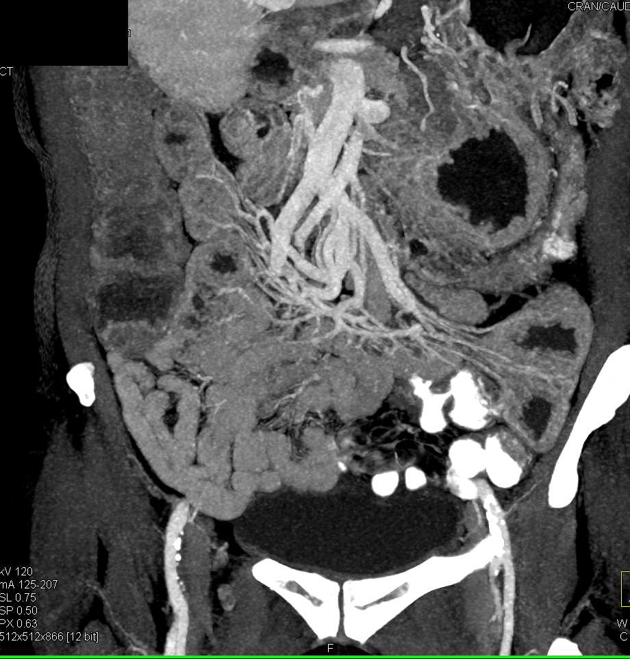 Inflammed Small Bowel - CTisus CT Scan